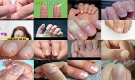 [指甲上有竖纹是肝不好]  指甲上有竖纹是怎么回事是癌吗  