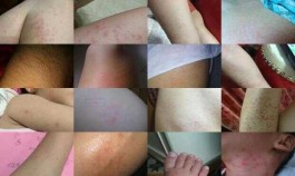 [过敏性红疹图片]  过敏性红疹图片孩子腿上出了很多大片红疹怎么办 